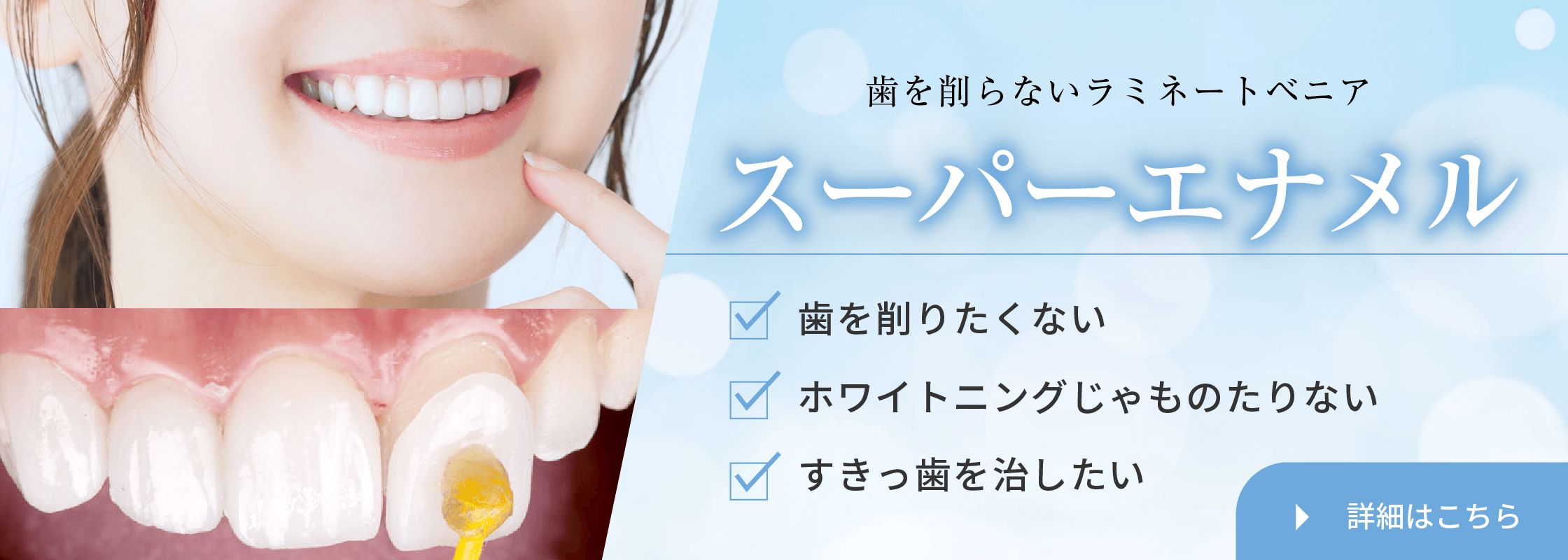削らないラミネートベニア・スーパーエナメル