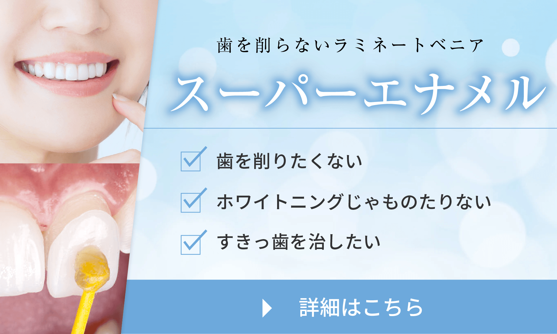 削らないラミネートベニア・スーパーエナメル